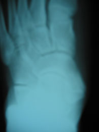 Accessory Navicular