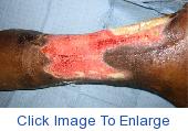posterior_wound_eTalkb