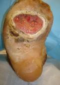 Plantar Forefoot Ulceration