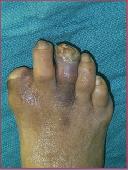 Hallux Amputation
