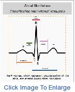 AtrilaFibrillation