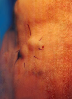 Post Biopsy � Lesion along DIPJ and PIPJ removed