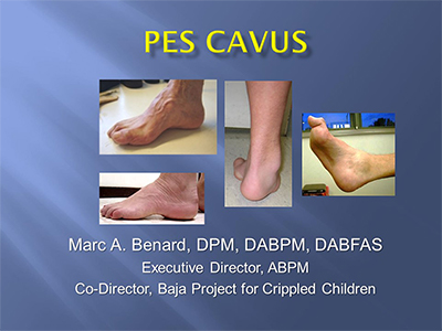 Pes Cavus by Marc A Benard, DPM