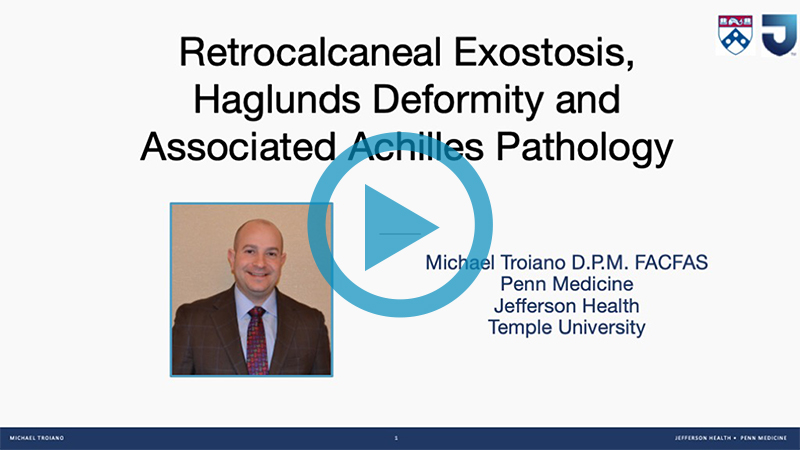 Retrocalcaneal Exostosis, Haglunds Deformity and Associated Achilles Pathology