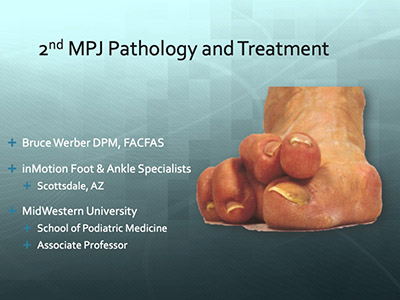 2nd MPJ Pathology and Treatment by Bruce Werber, DPM