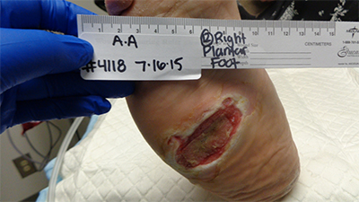 77-year-old obese female with history of type 2 diabetes and Charcot midfoot deformity