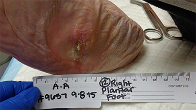 77-year-old patient's foot healed at 7.5 weeks