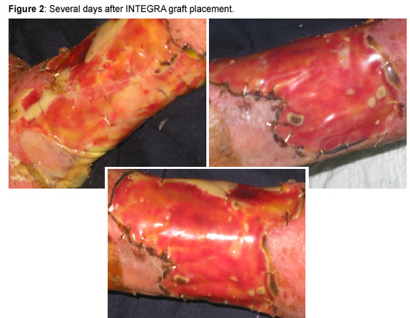 Figure 2: Several days after INTEGRA graft placement. 