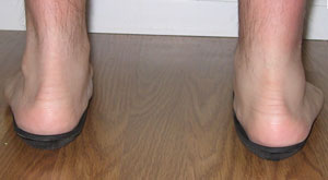 Fig. 2: Clinical view of left foot