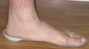 Fig. 2: Clinical view of left foot