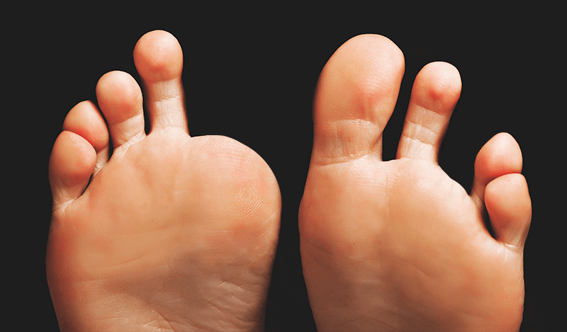 amputated toes feet