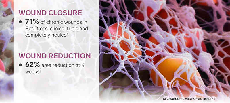 red dress actigraft OneMed to Distribute RedDress's ActiGraft Wound Care System in the Nordics