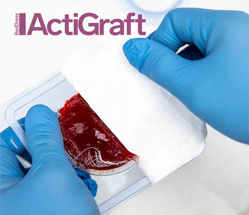 red dress actigraft RedDress and Inresa Announce French Reimbursement Milestone for ActiGraft  Following Positive HAS Assessment ActiGraft Receives ASA