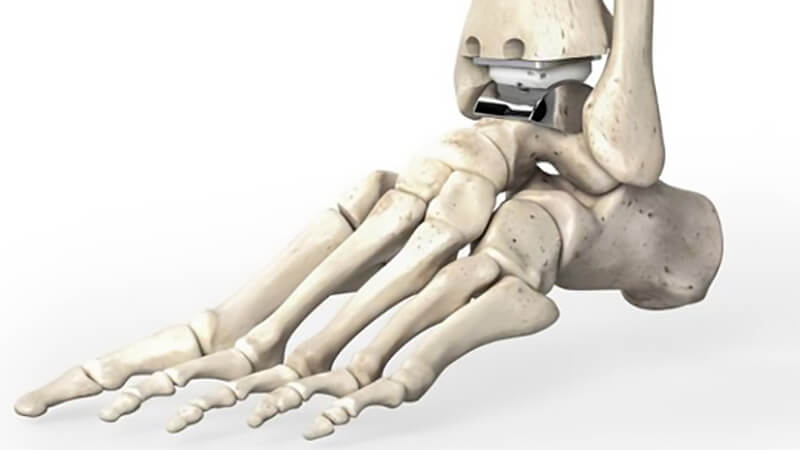 What's New in Podiatry - Journal Article Summary - Change in Gait ...