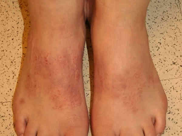 Podocon Application Rash PRESENT 5-Minute Podiatry Clinical Challenge - Week 10